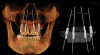 Figure 4 Implants and abutments placed, with the model turned off and the CBCT in view (left).
Implants and abutments in place with pinned model scan and CBCT off (right).