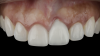 (2.) Preoperative retracted maxillary view of an implant-supported restoration at the site of tooth No. 9 demonstrating a peri-implant soft-tissue dehiscence extending approximately 3-mm apical to the gingival margin of tooth No. 8. Note the thin and erythematous marginal tissue evident at the zenith.