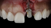 (3.) The crown was removed, and a partial thickness flap was reflected using a papilla-sparing incision design, which revealed that the implant was positioned too far facially and that its body was visible through a very thin layer of bone.
