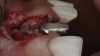 (4.) The crown was removed, and a partial thickness flap was reflected using a papilla-sparing incision design, which revealed that the implant was positioned too far facially and that its body was visible through a very thin layer of bone.