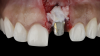 (5.) After the abutment and crown were recontoured, a soft-tissue graft was taken from the patient’s tuberosity and secured over the implant to add supracrestal volume, and the restoration was replaced. Note the planned position of the margin indicated in orange.