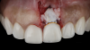 (7.) After the abutment and crown were recontoured, a soft-tissue graft was taken from the patient’s tuberosity and secured over the implant to add supracrestal volume, and the restoration was replaced. Note the planned position of the margin indicated in orange.