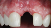 (11.) Preoperative close-up view of the tooth No. 9 site following implant placement and a period of healing, exhibiting a residual soft-tissue deficiency and an undulating facial soft-tissue morphology.