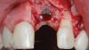(12.) Flap reflection to assess the position of the coronal aspect of the implant and facilitate soft-tissue grafting.