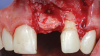 (13.) A soft-tissue graft from the tuberosity was placed to augment the supracrestal soft-tissue.