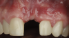 (16.) Three-month postoperative photograph demonstrating a positive change in the morphology of the soft tissue; however, the volume remained deficient when compared with that of tooth No. 8.