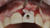 (17) Coincident with crown delivery, a second tuberosity graft was utilized to augment the supracrestal soft tissue.