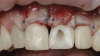 (18.) Coincident with crown delivery, a second tuberosity graft was utilized to augment the supracrestal soft tissue.