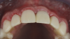 (20.) Four-month postoperative frontal and occlusal views revealing an ideal position of the tooth No. 9 margin in relation to its contralateral counterpart and an abundant amount of supracrestal soft tissue.
