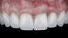(21.) Eight-month postoperative frontal and occlusal views of the final restorations demonstrating continued stability of the gingival margin and volume.