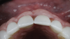 (22.) Eight-month postoperative frontal and occlusal views of the final restorations demonstrating continued stability of the gingival margin and volume.