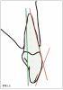 (1.) Rendering of a maxillary incisor with red lines representing the crown contours that should be used with caution during implant planning because they can result in angulation or placement that is too far facial and a green line representing a more appropriate implant alignment that is parallel and slightly palatal to the long axis of the tooth.