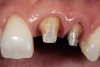 Figure 3  Dark teeth or teeth requiring restorations that are more opaque for masking often require the margin to be carried subgingivally, as with this central and lateral incisor.