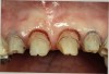 Figure 9  The decision was made to perform a gingivectomy, leaving a 1-mm sulcus, then prepare the teeth 0.5 mm subgingivally on the same day.