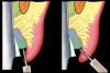 Figure 12  If electrosurgery is necessary in either the normal or altered eruption patient, the correct inclination of the electrosurgery tip is important. Left. Illustration shows the electrosurgery tip being held parallel to the preparation and  resting on the previously placed retraction cord. Right. Representation of the incorrect inclination of the electrosurgery tip. The tip is inclined and will result in the removal of excessive gingival tissue.