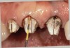 Figure 14  Very dark roots and 3 mm of sulcus depth make the possibility of recession a concern. On the incisors, the decision was made to perform a gingivectomy and create a 1-mm sulcus, followed by placing the margins 0.5 mm below tissue. On the canine a gingivectomy would result in an excessively long tooth compared to the opposite canine, so the decision was made to prepare one-half the depth of the 3-mm sulcus below tissue and hope for no recession. If any occurs, the margin should remain below tissue.