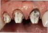 Figure 15  The gingivectomy on the incisors was performed, leaving a 1-mm sulcus depth.