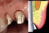 Figure 16  The first step in controlling margin placement is to prepare the tooth even with the gingival margin.