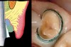 Figure 22  When the impression cord on the canine is removed, there is an adequate space created for the impression, with no soft tissue overhanging the margins to trap or tear the impression material. Note this margin is 1.5 mm subgingival, and 2 cords still remain.