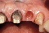 Figure 23  View of the soft tissue environment 9 months after the extraction of the lateral incisor. Note the tissue health around all the teeth and the lack of recession.