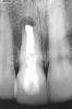 Figure 17  Periapical radiograph indicating periapical pathology and failing root canal.