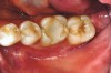 Figure 1a  A patient presents with large direct composite restorations and multiple crack lines in teeth Nos. 18 and 19. Tooth No. 19 was symptomatic to biting pressure.