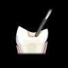 Figure 3  The acute transition from the proximal box to the occlusal surface is flattened to create a smooth slope that avoids creating steep angles to the long axis of the tooth.