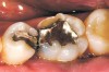 Figure 6a  A patient presents with a fractured mesiolingual cusp, a large amalgam restoration, and a crack line across the distal marginal ridge on tooth No. 19. Note only a thin rim of enamel remains at the site of fracture.