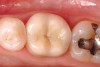 Figure 9g  The final restoration provides cuspal coverage and restores the anatomical contours of the tooth.