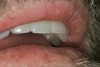 Figure 4  FUNCTIONAL HARMONY These restorations are in balance between the muscles of the lips and the tongue; this positional balance is referred to as the neutral zone.