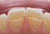 Figure 8  CLINICAL EXAMPLES An example of excessive lingual tooth wear in a patient with a restricted envelope of function.