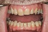Figure 11  CLINICAL EXAMPLES An example of a vertical wear patient; note the chipping and wear confined to the anterior teeth.
