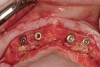 Figure 12  Anticipated bone grafting simultaneous with implant placement.