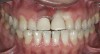 Figure 11  Preoperative photograph of a case in which the patient refused surgery and orthodontics. The treatment goal was to do minimal preparation and use a tough material due to the general medium-to-high risk in every area; obtaining a seal was possible.