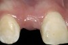 Figure 2  Congenitally missing maxillary right lateral incisor.