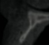 Figure 3  CBCT sagittal view. Note the extent of alveolar ridge deficiency.