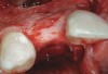 Figure 7  Post-augmentation alveolar ridge width net gain of 7 mm (7 months).