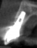 Figure 10  Two-year post completion, CBCT sagittal view.