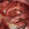 Figure 12  Preparation of left sinus augmentation and alveolar ridge split.