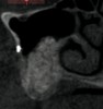 Figure 15  Seven months post-graft CBCT.