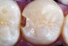Figure 4. AND Figure 5) The adhesive preparation for composite restorations allows a more conservative design than its amalgam counterpart.