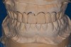 Figure 1  The proposed gingival alteration marked on the cast.