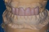 Figure 2  Laboratory alteration of the gingival contours in the diagnostic wax-up.