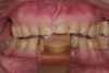 Figure 4  Interocclusal registration made at the approximate OVD for rehabilitation.