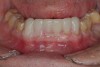 Figure 14  After matrix removal. Anteriors are provisionalized with no flash on posteriors.