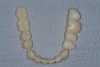 Figure 25  The provisional is segmented based on how the case is to be impressed and how the interocclusal record is to be fabricated.