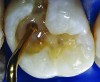 Figure 13. AND Figure 14. To ensure optimal internal adaptation, an AO2 shaded flowable composite (G-aenial Universal Flo, GC America) was applied as a cavity liner and uniformly distributed on the pulpal floor with a ball-tipped instrument and light cured for 20 seconds.