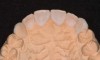 Figure 8  Palatal anatomy restored with wax on stone model.