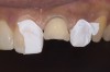 Figure 9: Tooth No. 9 minimally prepared for resin layering on the labial surface.