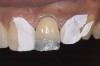 Figure 11  Tooth No. 9 with a palatal shelf of nanofilled resin.